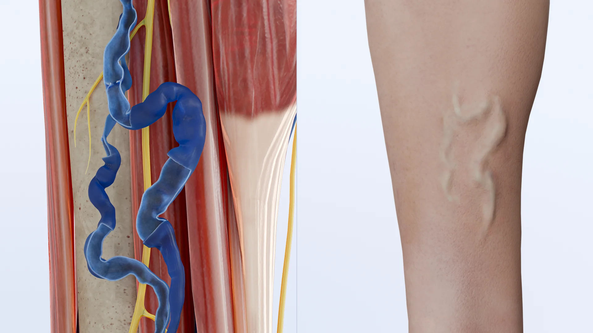 tromboflebitis-s-ntomas-causas-diagn-stico-y-tratamiento